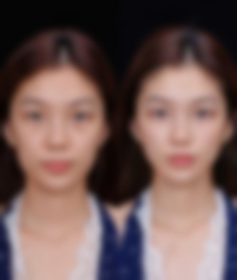 三、隆胸至佳时机之心理状态因素