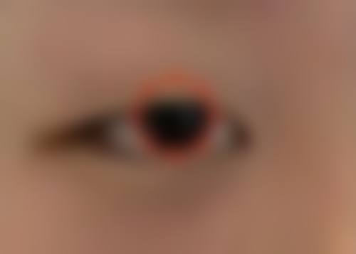 三、开眼角疤痕去除的光电类治疗