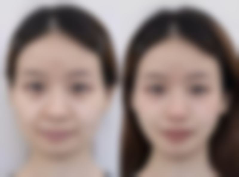 五、三点定位双眼皮手术实例分享