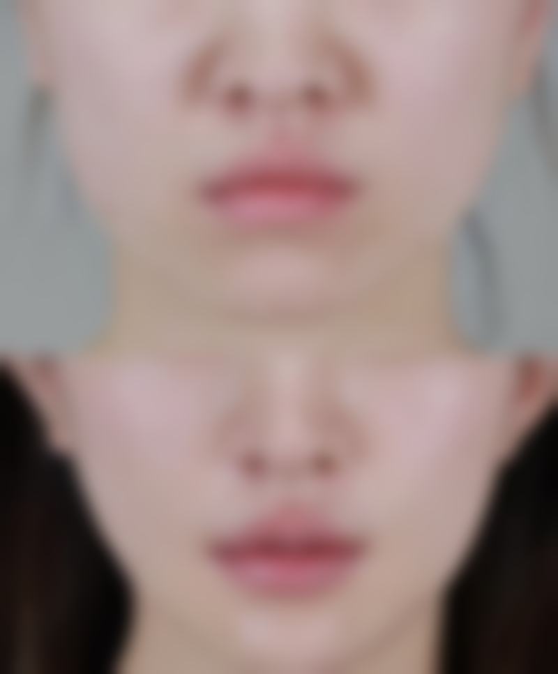 二、了解埋线双眼皮术后修复过程