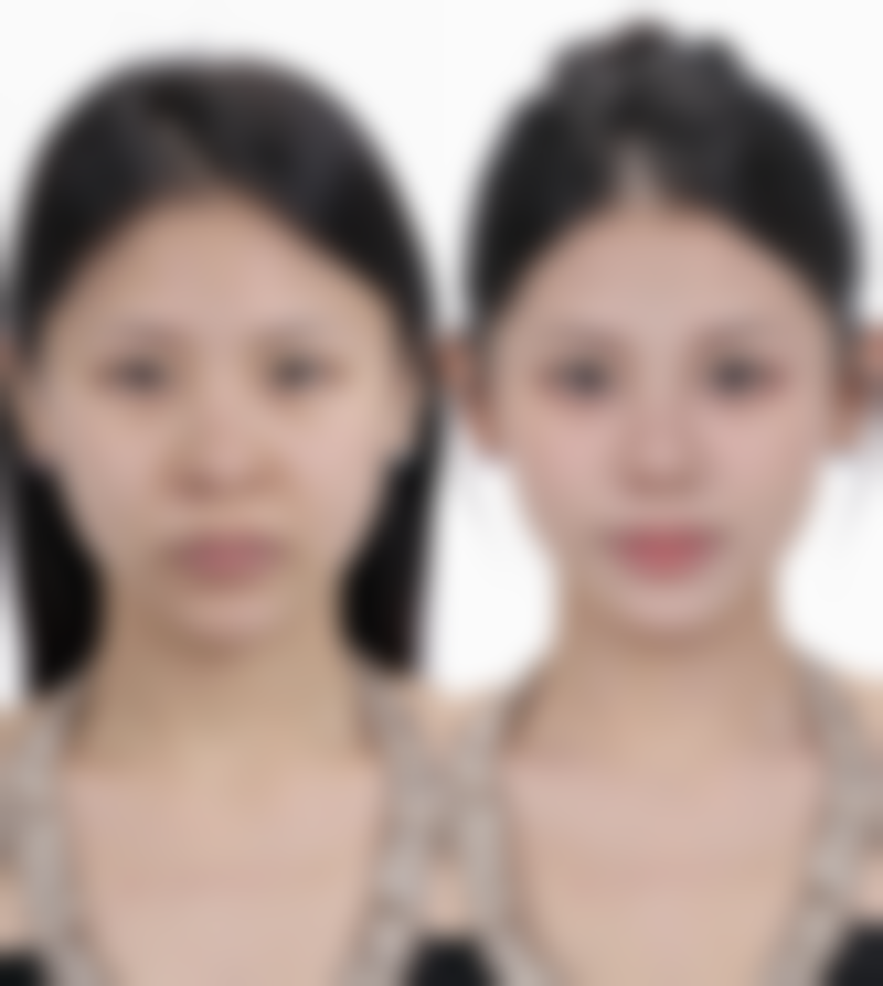 三、影响女人隆胸危害程度的因素