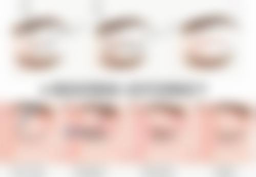 一、了解内切眼袋手术及疤痕增生原因