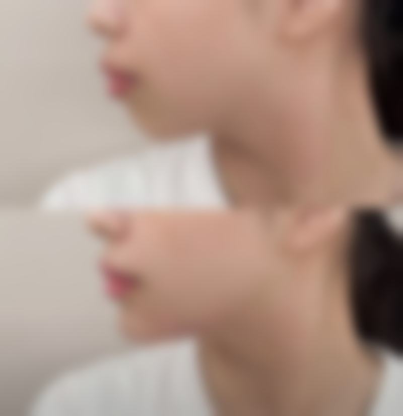 三、筋膜恒久无痕双眼皮的独特打造方式