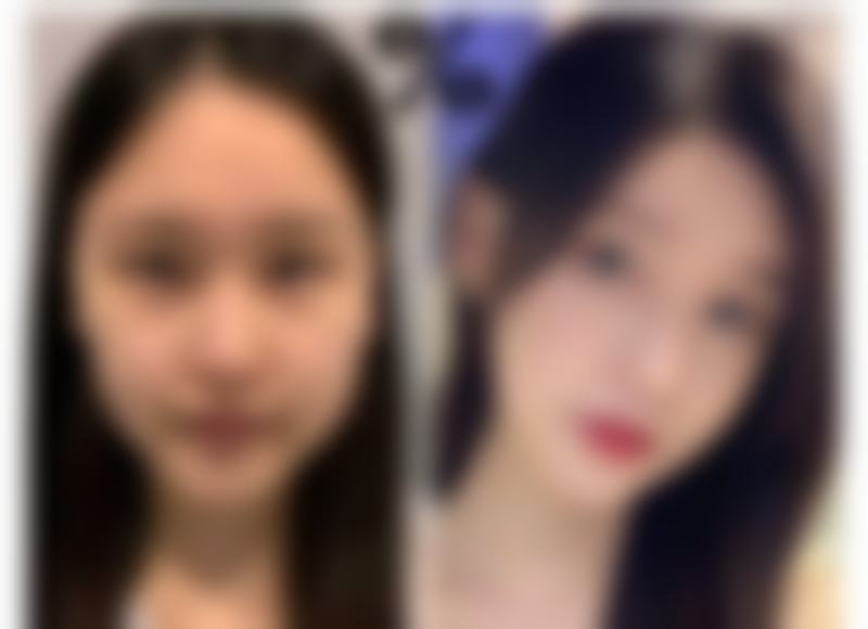 疤痕体质胸前疙瘩怎么消除？这不是啥无解的难题。只要咱们了解这些消除方法，根据自己的情况选择合适的方式，再加上耐心和坚持，相信胸前的疙瘩一定能慢慢消除。希望大家都能早日摆脱疤痕疙瘩的困扰，重新拥有光滑漂亮的皮肤！